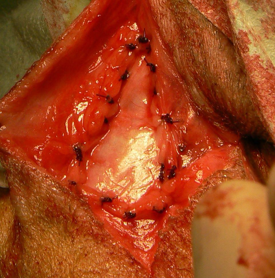 Prothèse de fascia lata suturée aux muscles du périnée.