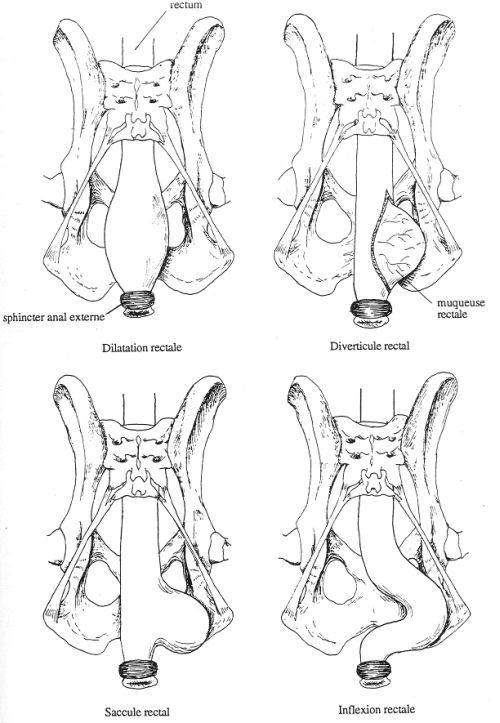 Déformations rectales rencontrées dans les hernies périnéales