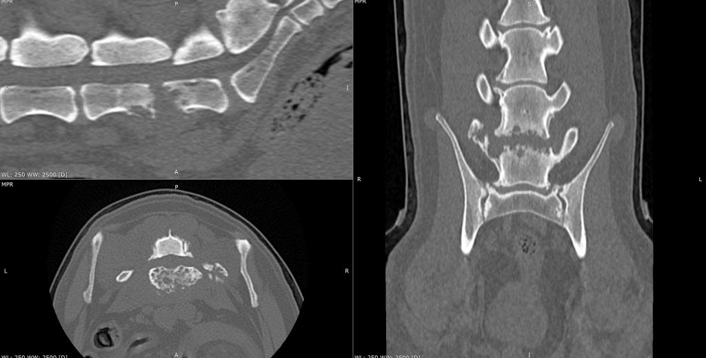 3D_MPR_-_ORION_TOUMIEUX_-_25_07_2025_10_15_34_-_OS_RACHIS_1.0_0000