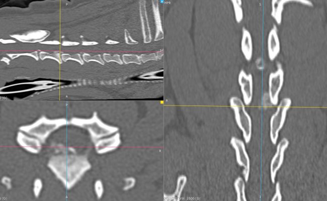 3D_MPR_-_hirault_ULA_-_12_11_2025_20_04_01_-_OS_RACHIS_1.0_0000