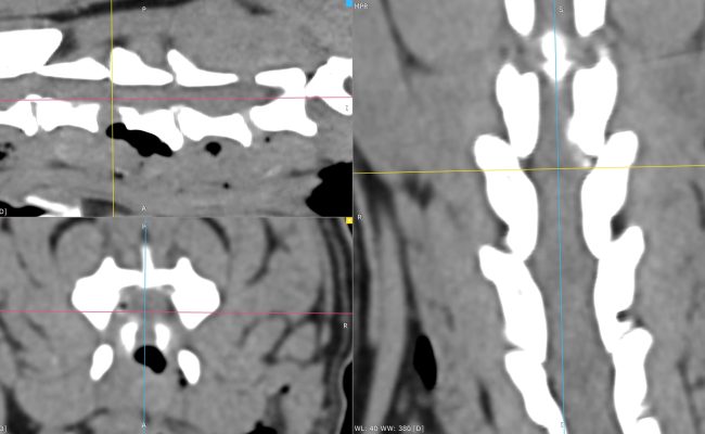 3D_MPR_-_hirault_ula_-_14_11_2025_21_25_01_-_TISSUS_MOUS_RACHIS_1.0_0000