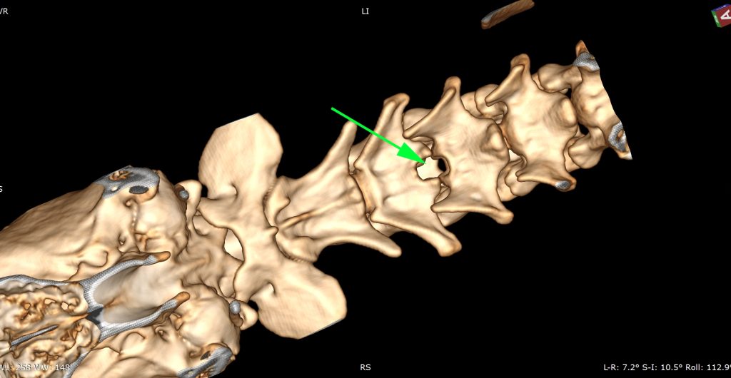 3D_VR_-_RIPOUTEAU_POST_OP_TOM_SELLEK_-_18_12_2025_20_18_43_-_TISSUS_MOUS_RACHIS_1.0_0000